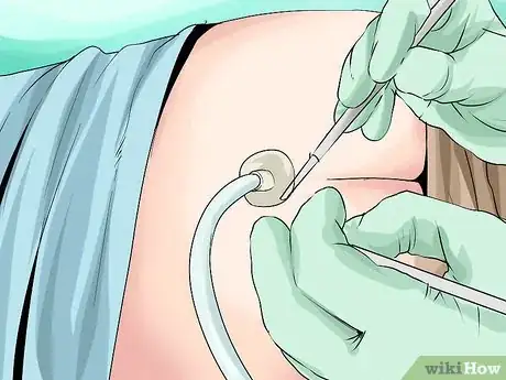 Image titled Treat a Pilonidal Cyst Step 2