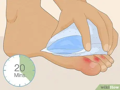 Image titled Treat a Sore Toe Step 2