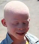 White hair caused by albinism