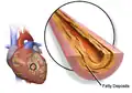 Fatty deposits causing coronary artery plaque