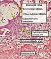 Histopathology of a chorionic villus, in a tubal pregnancy, with labeled cytotrophoblasts and syncytiotrophoblasts.